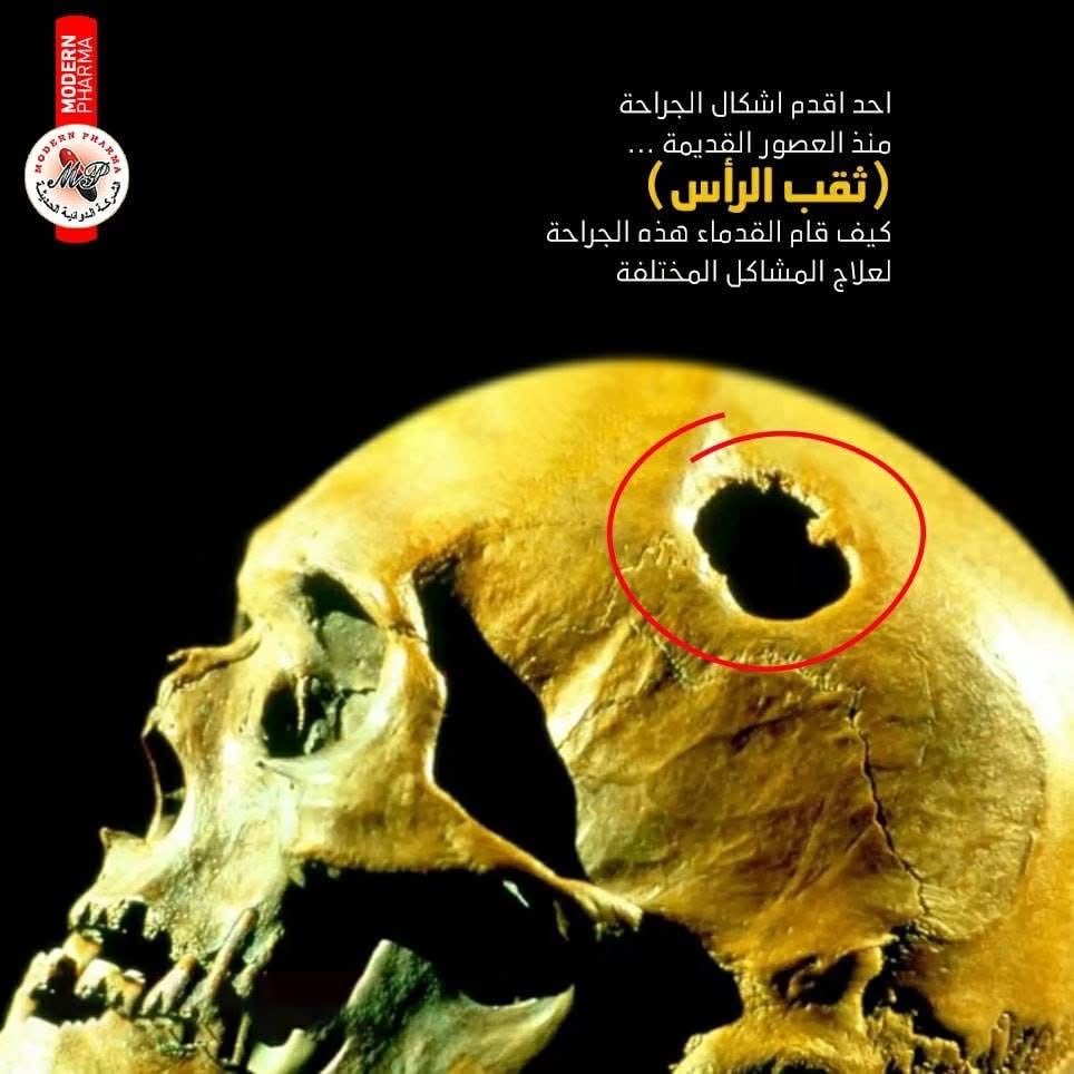 oglxw7's tweet photo. طيب هقول شيء مبهر أكتر الإنسان البدائي كان عنده تقنيه علاج عبارة عن "ثقب المخ" بيعمل فتحه حرفيا في دماغ الشخص، طبعا دا بدون تخدير وبدون ادوات جراحية متطورة كان حرفيا باستخدام حجر حاد. 

ومش معروف دا كان لعلاج مرض ايه، بس الشيء مشترك مكان الثقب ومعرفتهم بالأماكن الغير مميته. https://t.co/Zu8L7jn5ny