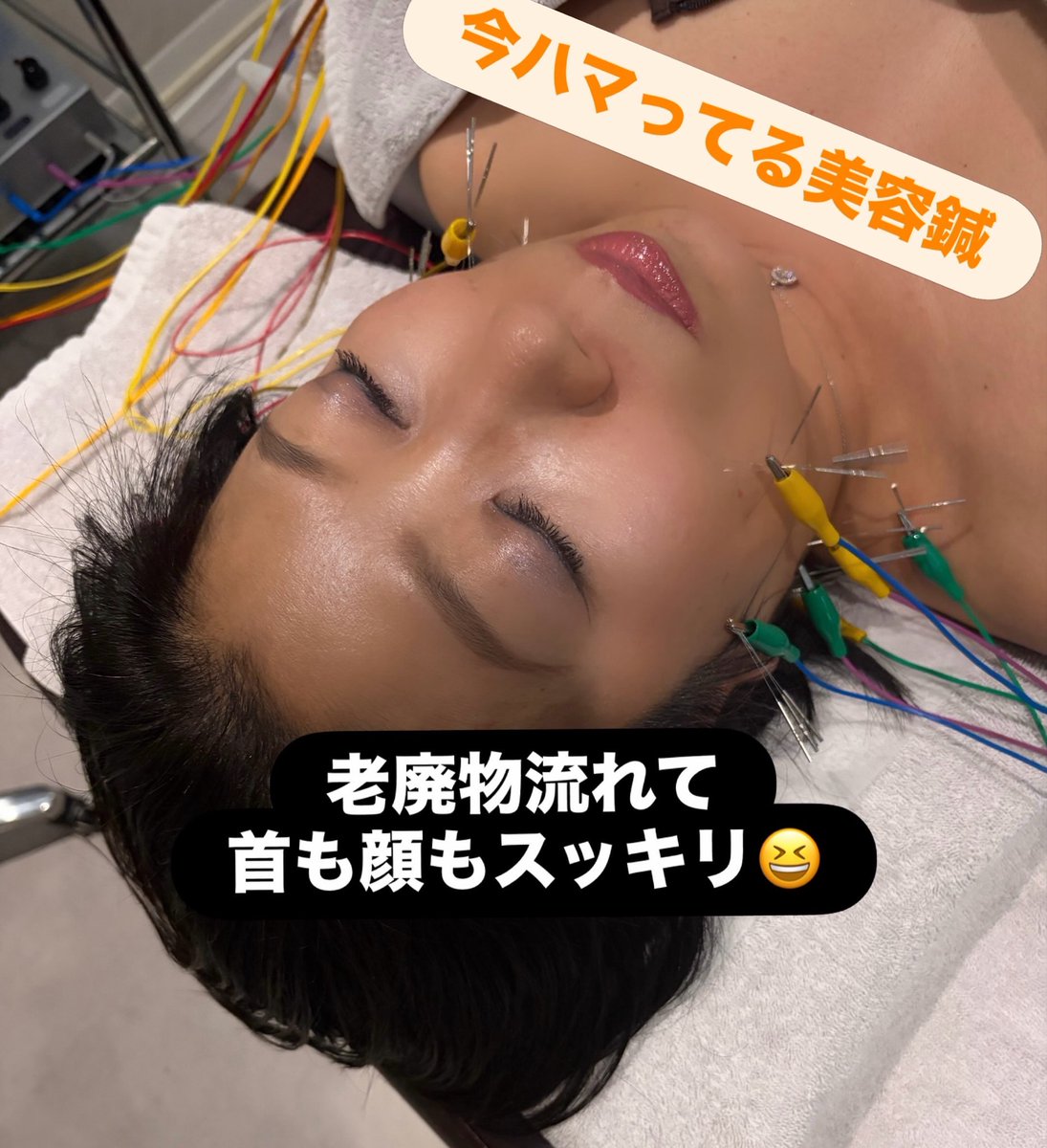 harumi7743's tweet photo. 今日もどハマり中の美容鍼😍@ginza_harrichi 頭、首の滞ってる老廃物を流すと整形級にリフトアップされる😆
どんだけ流れてないんだwww https://t.co/7ICl7MA1eh