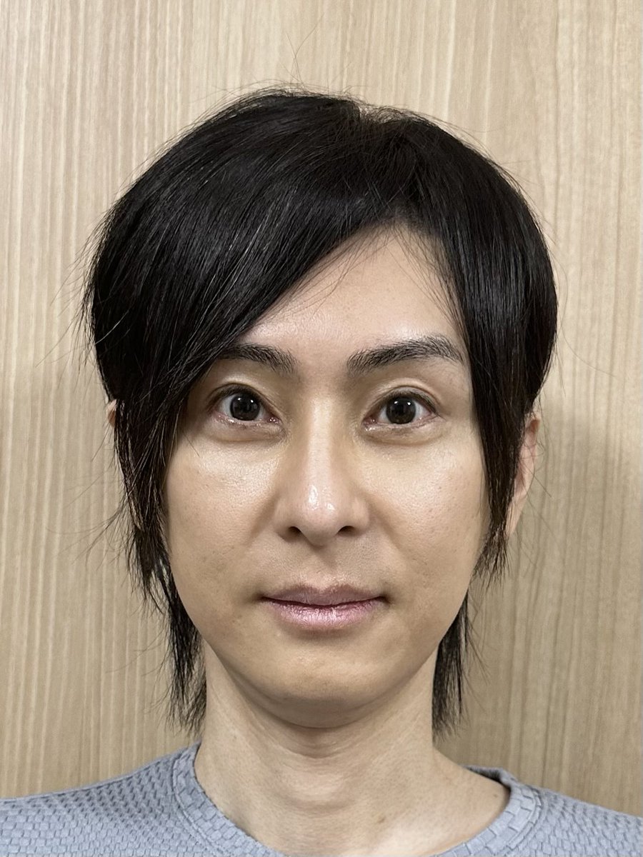 zettaibikan's tweet photo. 骨切りしてから1年が経ったので写真比較してみました！

両顎手術＋輪郭4点（輪郭3点＋頬骨セットバック）
術前と術後1年の比較です。

いかがでしょうか？
自分では見慣れてしまいましたが、写真で見ると結構印象が変わった感じがありますね。

最近、周りの人にも「また顔小さくなった？」と言われるので、術後2〜3ヶ月の頃でも結構腫れてたんだなーと感じています。

【顔全体の変化】
顔の縦幅の変化は実質−5〜6mm（多分）。
頭の大きさは変わりませんが、全体的なバランスが整い、面長感は軽減したと思います。

【目元の変化】
頬骨セットバックの効果に加え、骨切りの小顔効果によって、相対的に目が大きく見えるようになったと思います。
術後2〜3ヶ月くらいは涙袋が綺麗にぷっくりしていたのですが、結局組織の腫れだったようで、半年もするとなくなってしまいました（残念）。
それでも、術前よりは涙袋はややハッキリしたし、なぜか目の下のこじわもちょっと改善しました。
頬骨セットバック時の下眼瞼のタイトニング効果？
OGカーブも自然な感じで残してくれています。
出目になったわけではないですが、目周りの窮屈な感じが軽減したので、割と目元の印象も変わったと思います。

【鼻の変化】
両顎で上顎を3mm挙上してるので小鼻が横に少し広がっているはずなんですが、広がったという実感はありません。
よーく見たら広がってるのかな？
cinch sutureの効果でしょうか？
小鼻の広がりは覚悟していたので良かったです。
鼻中隔がほんの少し左に曲がってしまったので（外鼻変形はなし）、しばらくは左の鼻閉が気になりましたが、時間が経ったら曲がりも改善し、支障ないくらいになりました。

【口元の変化】
結構変化していると思います。
術前はあまり気にしたことなかったのですが、術後は口元の突出感が軽減しました。
上下ともにやや内反し、口唇が薄くなりました。
あと、ちょっとわかりにくいんですが、術前にあったマリオネットラインと直交するシワ？窪み？（ほうれい線の延長線みたいなやつ）が、術後は綺麗に消えた！

人中の長さ（17mm）は術前後でほとんど変わらず。口元が多少引っ込んだ分、Cカールはほんの少し減少したような感じがします。

ガミースマイルは改善！
術前は思いっきり笑うと歯茎が3〜4mmくらいは見えてましたが、今は1〜2mmくらい。
逆ガミーにもならず、とても自然。

【顎の変化】
4〜5mmの短縮と同時に、少し前方に出しています。
術後はオトガイ唇溝が出現！
横顔がめちゃ綺麗になりました。

顎は短くなったのですが、下唇が薄くなったので骨を切った程の短縮効果はないかも？
でも、計測したら下唇〜下顎は4〜5mmちゃんと短くなっていました。
下口唇からオトガイにかけての知覚鈍麻、軽い痺れ、拘縮感はまだあるのですが、もう40オーバーなので気長に待ちます。

下顎縁を短くした分、やや顎下のたるみや顎下腺が目立つようにはなりましたが、今はそこまで気にならず。
いつかペリカンするかも。

【たるみ】
物理的にたるんだとは思うのですが、予想してたよりは全然たるみは気にならないです！
もともとたるみも皮下脂肪も少ないというのもあるかと思います。
あと、術前、術後はソフウェーブ、HIFU、RFなどのデバイス治療はやりまくってました笑。

術後は両顎とオトガイ形成の効果でバブみが出たというか童顔化したので、たるみが気になるどころか術前より若く見られるようになりました。

尺度や色調など、極力同じ条件になるように調整していますが、自宅撮影なので完全に揃えるのはなかなか難しく。
顔の角度や表情なども若干異なりますが、僕の趣味で投稿しているものなのでご容赦ください。

執刀医は骨切り山ちゃんこと山本崇弘先生（@dr_yamachan）です⛰️

こちらの細かい要望を聞きつつも、手術の適応やプランについて慎重に考えてくださいました。
人生初の全身麻酔で、術前は色々と不安もありましたが、手術を受けて本当に良かったです。

山本先生、麻酔科医の金山先生、コントアクリニックの皆様、
ありがとうございました！