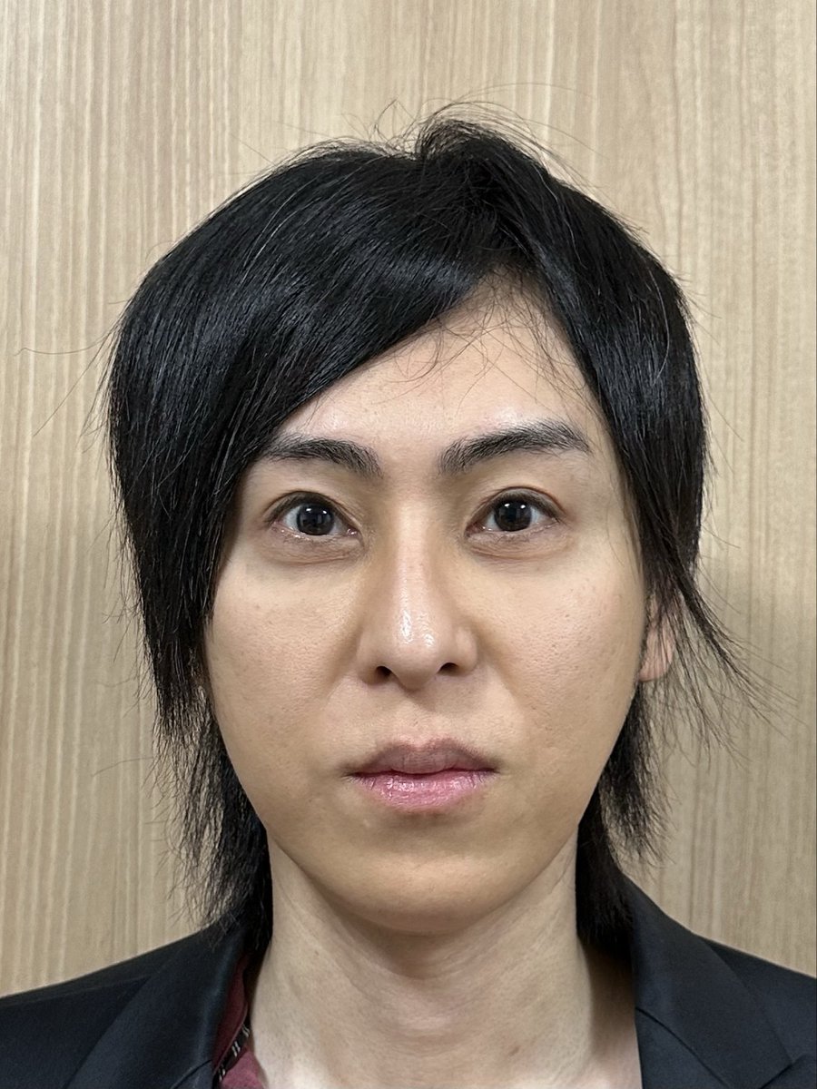 zettaibikan's tweet photo. 骨切りしてから1年が経ったので写真比較してみました！

両顎手術＋輪郭4点（輪郭3点＋頬骨セットバック）
術前と術後1年の比較です。

いかがでしょうか？
自分では見慣れてしまいましたが、写真で見ると結構印象が変わった感じがありますね。

最近、周りの人にも「また顔小さくなった？」と言われるので、術後2〜3ヶ月の頃でも結構腫れてたんだなーと感じています。

【顔全体の変化】
顔の縦幅の変化は実質−5〜6mm（多分）。
頭の大きさは変わりませんが、全体的なバランスが整い、面長感は軽減したと思います。

【目元の変化】
頬骨セットバックの効果に加え、骨切りの小顔効果によって、相対的に目が大きく見えるようになったと思います。
術後2〜3ヶ月くらいは涙袋が綺麗にぷっくりしていたのですが、結局組織の腫れだったようで、半年もするとなくなってしまいました（残念）。
それでも、術前よりは涙袋はややハッキリしたし、なぜか目の下のこじわもちょっと改善しました。
頬骨セットバック時の下眼瞼のタイトニング効果？
OGカーブも自然な感じで残してくれています。
出目になったわけではないですが、目周りの窮屈な感じが軽減したので、割と目元の印象も変わったと思います。

【鼻の変化】
両顎で上顎を3mm挙上してるので小鼻が横に少し広がっているはずなんですが、広がったという実感はありません。
よーく見たら広がってるのかな？
cinch sutureの効果でしょうか？
小鼻の広がりは覚悟していたので良かったです。
鼻中隔がほんの少し左に曲がってしまったので（外鼻変形はなし）、しばらくは左の鼻閉が気になりましたが、時間が経ったら曲がりも改善し、支障ないくらいになりました。

【口元の変化】
結構変化していると思います。
術前はあまり気にしたことなかったのですが、術後は口元の突出感が軽減しました。
上下ともにやや内反し、口唇が薄くなりました。
あと、ちょっとわかりにくいんですが、術前にあったマリオネットラインと直交するシワ？窪み？（ほうれい線の延長線みたいなやつ）が、術後は綺麗に消えた！

人中の長さ（17mm）は術前後でほとんど変わらず。口元が多少引っ込んだ分、Cカールはほんの少し減少したような感じがします。

ガミースマイルは改善！
術前は思いっきり笑うと歯茎が3〜4mmくらいは見えてましたが、今は1〜2mmくらい。
逆ガミーにもならず、とても自然。

【顎の変化】
4〜5mmの短縮と同時に、少し前方に出しています。
術後はオトガイ唇溝が出現！
横顔がめちゃ綺麗になりました。

顎は短くなったのですが、下唇が薄くなったので骨を切った程の短縮効果はないかも？
でも、計測したら下唇〜下顎は4〜5mmちゃんと短くなっていました。
下口唇からオトガイにかけての知覚鈍麻、軽い痺れ、拘縮感はまだあるのですが、もう40オーバーなので気長に待ちます。

下顎縁を短くした分、やや顎下のたるみや顎下腺が目立つようにはなりましたが、今はそこまで気にならず。
いつかペリカンするかも。

【たるみ】
物理的にたるんだとは思うのですが、予想してたよりは全然たるみは気にならないです！
もともとたるみも皮下脂肪も少ないというのもあるかと思います。
あと、術前、術後はソフウェーブ、HIFU、RFなどのデバイス治療はやりまくってました笑。

術後は両顎とオトガイ形成の効果でバブみが出たというか童顔化したので、たるみが気になるどころか術前より若く見られるようになりました。

尺度や色調など、極力同じ条件になるように調整していますが、自宅撮影なので完全に揃えるのはなかなか難しく。
顔の角度や表情なども若干異なりますが、僕の趣味で投稿しているものなのでご容赦ください。

執刀医は骨切り山ちゃんこと山本崇弘先生（@dr_yamachan）です⛰️

こちらの細かい要望を聞きつつも、手術の適応やプランについて慎重に考えてくださいました。
人生初の全身麻酔で、術前は色々と不安もありましたが、手術を受けて本当に良かったです。

山本先生、麻酔科医の金山先生、コントアクリニックの皆様、
ありがとうございました！