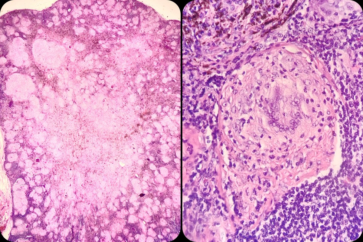 duckhuca's tweet photo. 🫁 Lobectomy ➕ Lymphadenectomy.  Treatment:  immunotherapy.
🔬 Lung Adenocarcinoma.  Non-necrotising granulomatous lesion.

#LungPath #LungCancer https://t.co/aP2O7F4RO0