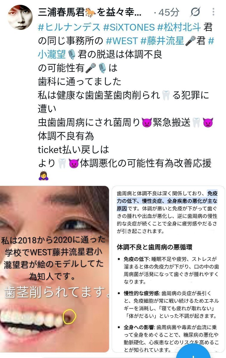 haruma11111's tweet photo. #STAR #加藤ミリ🎤 氏の体調不良は望んだ事ではなく
🎤は
歯科に通ってました
私は健康な歯歯茎歯肉削られ🦷る犯罪に遭い
虫歯歯周病にされ菌周り👿緊急搬送🦷👿
体調不良有為
#WEST #藤井流星 君 #小瀧望 君も同様の為
メンバーバッシングされたのは
犯罪隠蔽しようとする情報操作の為で✕
改善応援🙇‍♀️ https://t.co/3lBYlCXNdm