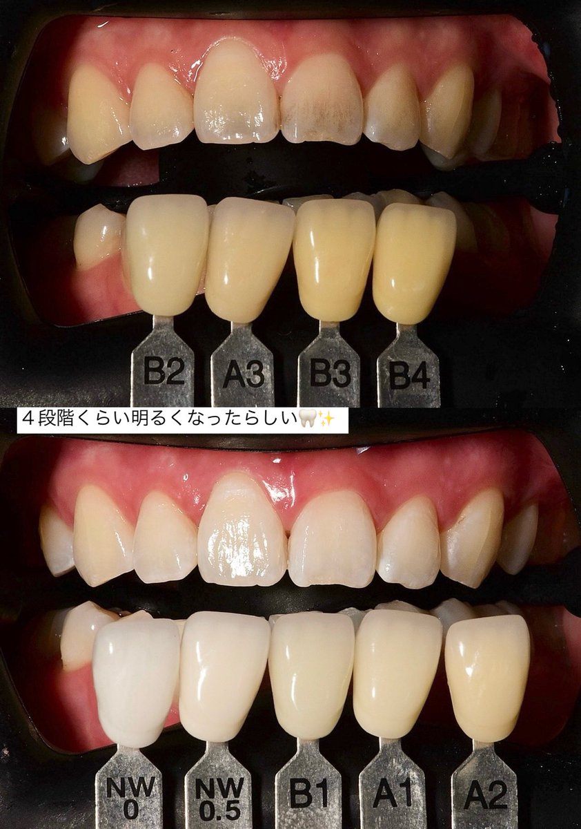 🦷ミソラウム歯科
韓国で初ホワイトニングしてきた！
非喫煙者でコーヒー飲まないけどお茶良く飲むから歯の色と茶渋やばかった(汚いもの見せてごめん)
1回でこんなに白くなるならもっと早くやれば良かった以外の感想がでない
ラミネートするか迷ってたけど自前の歯でホワイトニング継続でいいかも🥴(PR)