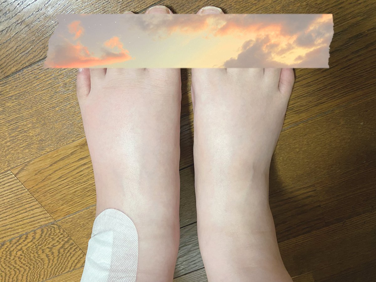 chihiro_dc's tweet photo. 左足の蚊に刺されが腫れに腫れてくるぶしが痛いまできた。庇ってるせいか浮腫まくって笑う https://t.co/nivgE8XMOV