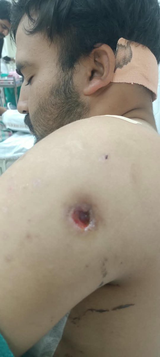 FSUIINDIA's tweet photo. #SeafarersInWar 
Forced into a war zone. Hit by 4 drones. 8 bomb splinters still inside his body. Family paying the hospital bills.
OS Rahul Choudhary (INDoS 23ZQ1563) joined MV VOLGAA 4007 (IMO 8728816) on 27 July 2026. Crew refused in writing to sail to Russia. They were forced to proceed.
19 August 2026: vessel attacked by 4 drones. Rahul suffered fractured ribs, shoulder fracture, head injury, abdominal injury and multiple splinters in thigh, leg, chest and head.
Rescued by Russian Navy. Incomplete treatment in Novorossiysk. Ticket given only till Delhi. Family paid the rest. Luggage and documents destroyed in the blast.
Now admitted at DMC Hospital, Ludhiana. Doctors confirm 8 splinters remain inside. Some cannot be operated — risk of paralysis.
Till date: no wages, no medical cover, no compensation, no repatriation costs.
This is abandonment after forcing a seafarer into a war-risk area. Clear MLC 2006 violation.
FSUI demands DG Shipping act now: pending wages, full medical care, injury and war-risk compensation, reimbursement of travel and personal effects.
A young seafarer is fighting for his life. Those who sent him there have walked away.
#SeafarersRights #MLC2006 #AbandonedSeafarer #DGShipping #FSUI
@dgshipping_IN 
@shipmin_india 
@RusEmbIndia 
@FSUIINDIA 
@ITFglobalunion 
@IMOHQ