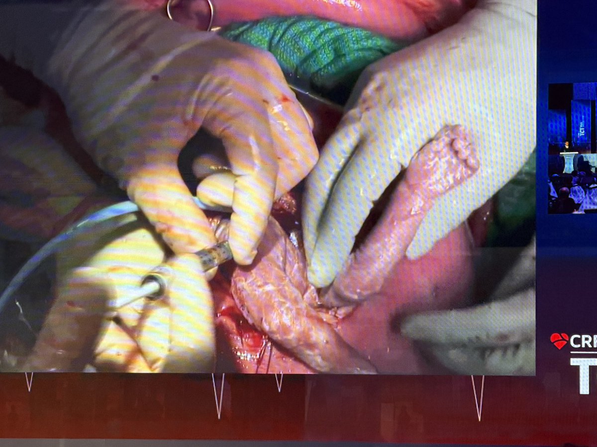 Hragy's tweet photo. Intra uterine surgery , please look at pulling the baby’s arm to put an IV! 
@Dr_HaniNajm presented the video details of an extremely never before surgery in utero- but I was amazed by the fetus’s little arms! 
#TCTMiddleEast2026 @TCT_ME_ https://t.co/Bc8k8dj7Ge
