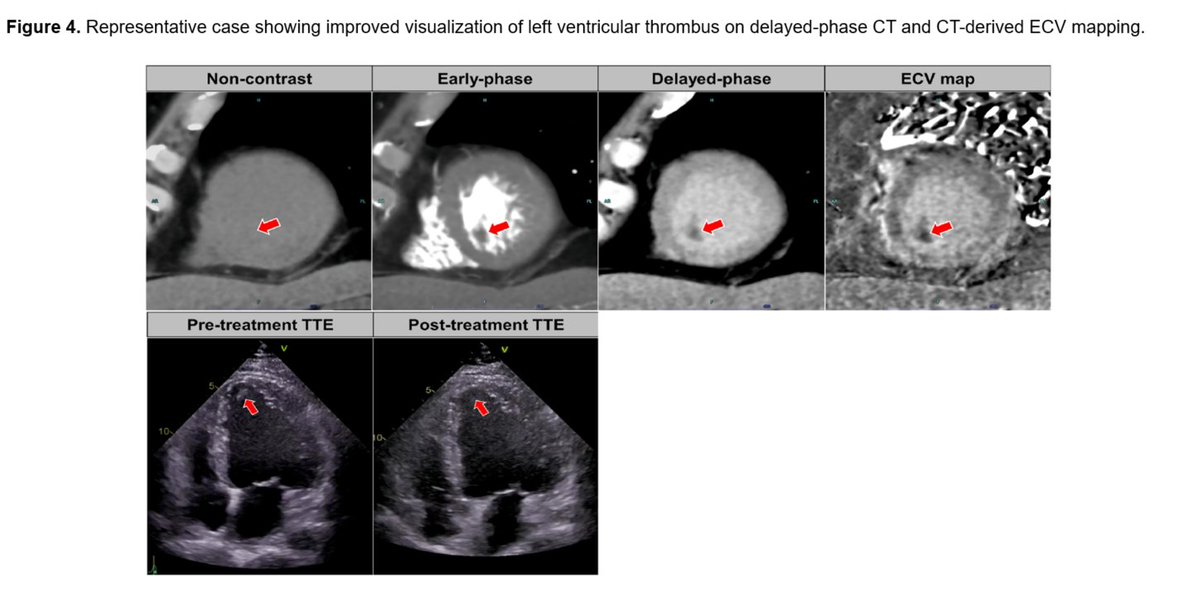 journalCCT's tweet photo. The study from Takaoka et al. showed that delayed-phase cardiac CT and CT-derived ECV maps improve detection of left ventricular thrombus, with AUCs of 0.95 and 0.98, respectively, compared with 0.78 for early-phase and 0.55 for non-contrast imaging.
https://t.co/1vyiDtPT7K https://t.co/Cet5c9AVn7
