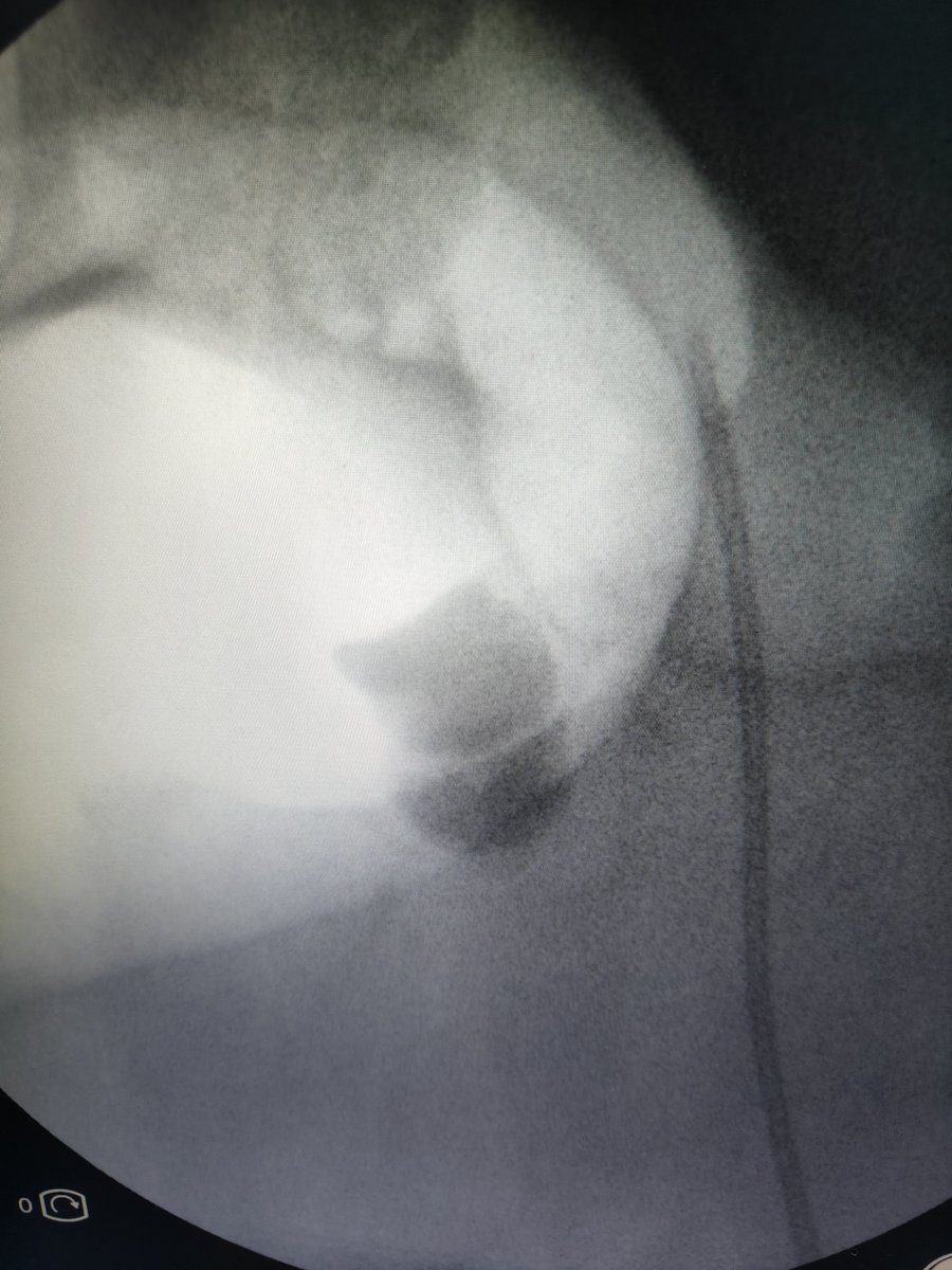 Eslam_wareth's tweet photo. In CKD patient with raised serum creatinine 2.5 
You must do your job so quickly 
Complete clearance
#pcnl
#stones
#endourology
#eau
#kidney https://t.co/thvtOt2URn
