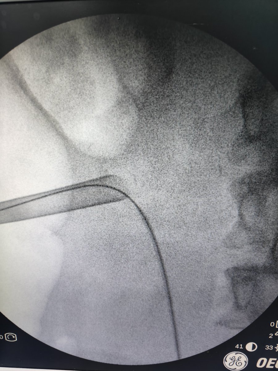 Eslam_wareth's tweet photo. In CKD patient with raised serum creatinine 2.5 
You must do your job so quickly 
Complete clearance
#pcnl
#stones
#endourology
#eau
#kidney https://t.co/thvtOt2URn