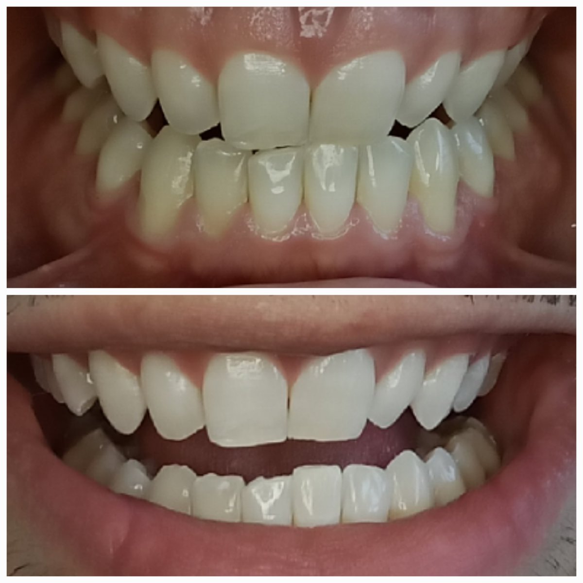 AbqTeethWhite's tweet photo. A quick 60 minute teeth whitening treatment is enough to change your appearance drastically. In 60 minutes you'll get the confidence needed to slay that interview, date, public speaking engagement, or crush those photos. Book today: https://t.co/gT34OX2JQo
#teethwhitening https://t.co/GXG9xvrvGm