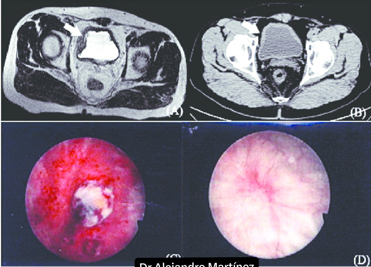 Wmakisprotocol's tweet photo. Hello everyone. Id like to share good news. My patient father’s bladder cancer (T2a G3) shows complete remission in todays MRI scan. After following our protocol with 6 days on 1 day off 444mg fenbendazole, ivermectin 12mg 4 days on and 3 days off, DMSO  taking 3 teaspoon daily for 3 days on and 4 days off and taking NAC 600 mg daily for 7 weeks with 2 cycles of Gemcitabine.

Wow wo wow  you can't make this up 
This is revolutionary Thisis the future of cancer treatment...Big pharma be scared. 

@joeroganhq @RobertKennedyJr #ivermectin