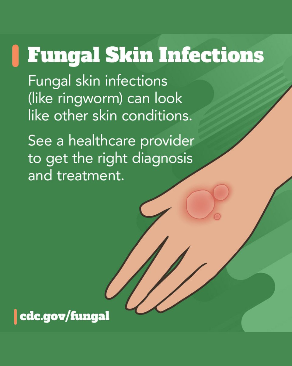 IMMYdiagnostics's tweet photo. That "ringworm" that won't respond to the cream? It might not be ringworm. Or it might be a fungus the over-the-counter treatment doesn't cover.

Fungal skin infections can look almost identical to eczema, psoriasis, or a bacterial skin infection, which is exactly why they're so often treated by appearance alone instead of confirmed.
Wrong diagnosis, wrong treatment, longer time to actually clearing it up.

This Fungal Disease Awareness Week: if a skin condition isn't responding the way it should, see a healthcare provider for an actual diagnosis and think fungus.