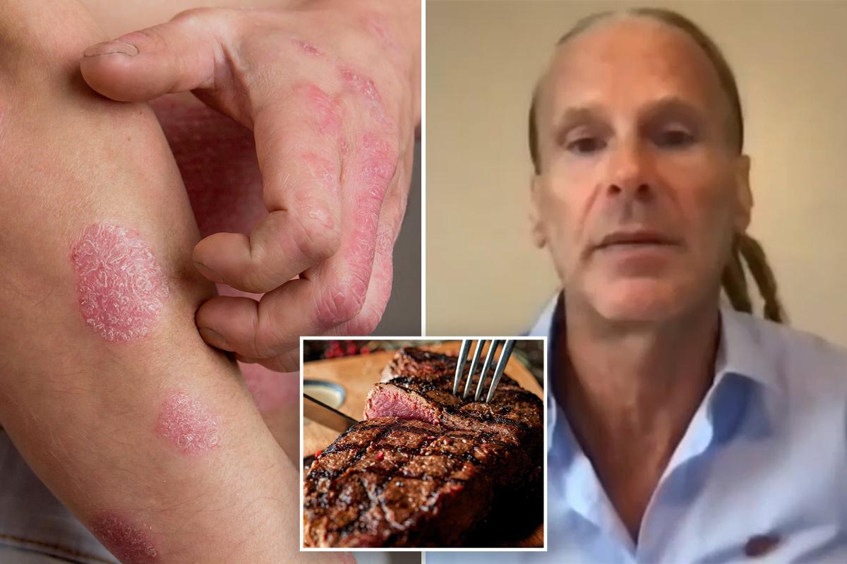 nypost's tweet photo. Florida man says meat-only 'lion diet' cleared psoriasis, ended decades of depression https://t.co/rg67K0c29w https://t.co/WsRcRmkSDW