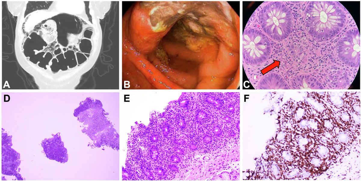 MissMinnieRdiag's tweet photo. Immune effector cell-associated enterocolitis(IEC-EC) 
•CAR-T 療法後1～3 か月で発症。非血性下痢の症状。
•CTでは43%の症例（(n  = 6/14)で小腸または大腸の炎症を認め、その中の2例はびまん性大腸気腫症を認めた（図）。

＃Rdiag
参考：https://t.co/VPL8UAe6WN https://t.co/Pcta79dMR1