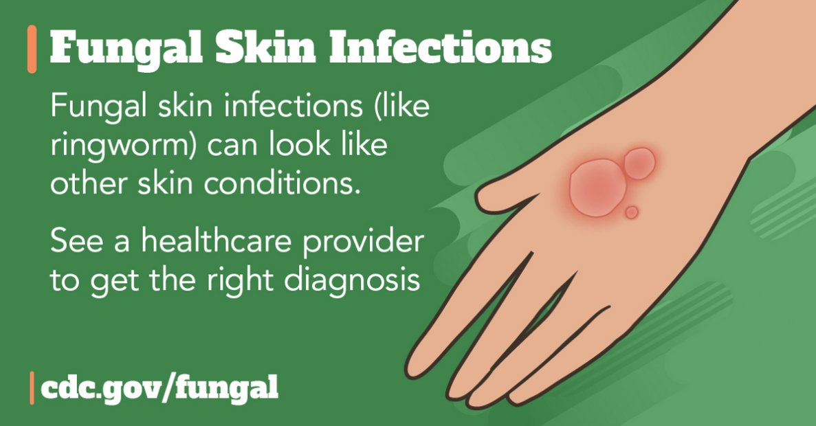 PHLPublicHealth's tweet photo. Clinicians: Fungal skin diseases can be confused with other skin conditions. Test to confirm the diagnosis and avoid prescribing concurrent use of antifungals and topical steroids. #ThinkFungus26 https://t.co/fEW70OS3vp https://t.co/jcg6LrqRS4