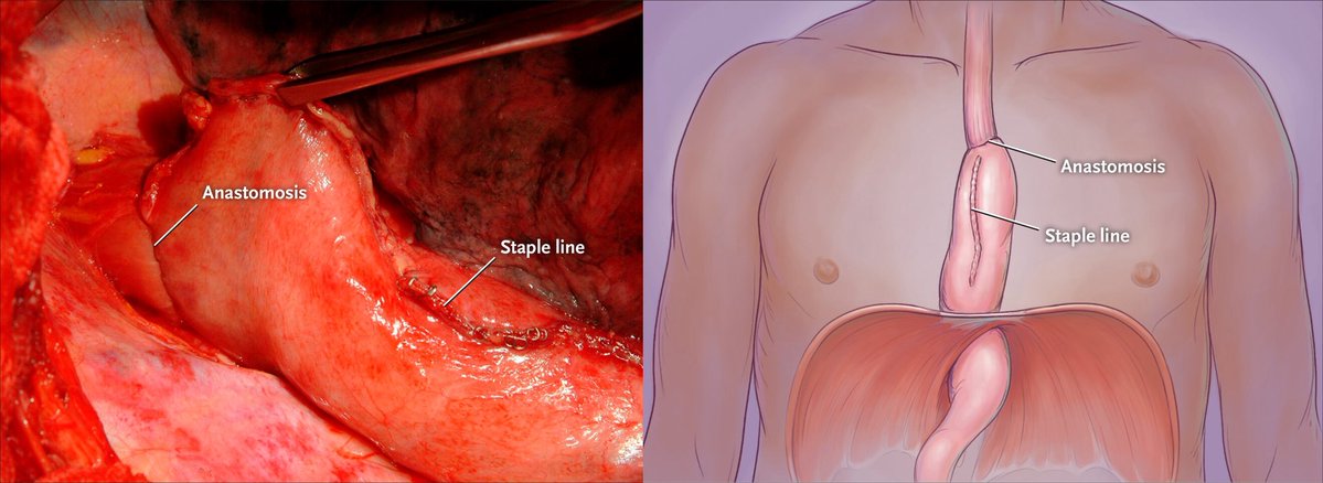 DraMartinezLago's tweet photo. 🧬 Esophageal cancer | NEJM Review

🔀 SCC and adenocarcinoma: distinct diseases
🎯 Treatment increasingly guided by histology + biomarkers
🧪 PD-L1 | HER2 | CLDN18.2 | dMMR
🚀 Toward more personalized multimodal care

🔗 https://t.co/q0eNWcSlAT https://t.co/G3tatFPRo3