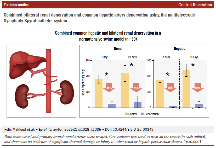EuroInterventio's tweet photo. In a preclinical model, combined renal and hepatic artery denervation using a single radiofrequency system achieved substantial and sustained reductions in renal and hepatic norepinephrine, without collateral tissue injury. 

Read more here: https://t.co/ft2DHe4qd5

#RenalDenervation #Hypertension #CardiovascularResearch 

@FelixMahfoud @Kandzari @PamTaubMD @markus_schlaich