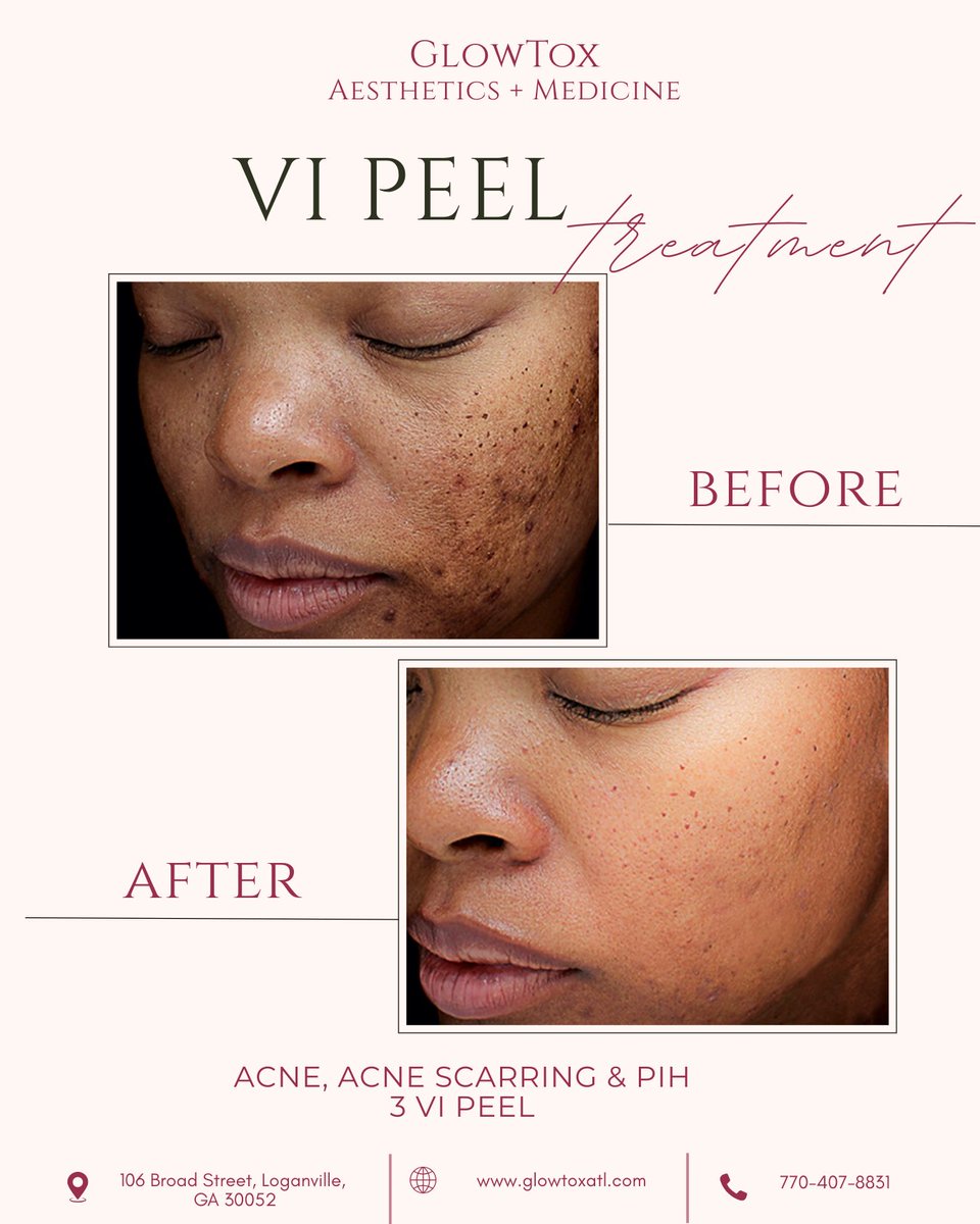 TanekaMyrelc's tweet photo. Your skin can change. See these VI Peel before-and-after results from different skin journeys. This professional chemical peel helps improve acne, hyperpigmentation, acne scars, uneven tone, and overall texture. Start your journey at GlowTox https://t.co/FTVfaAuYUN