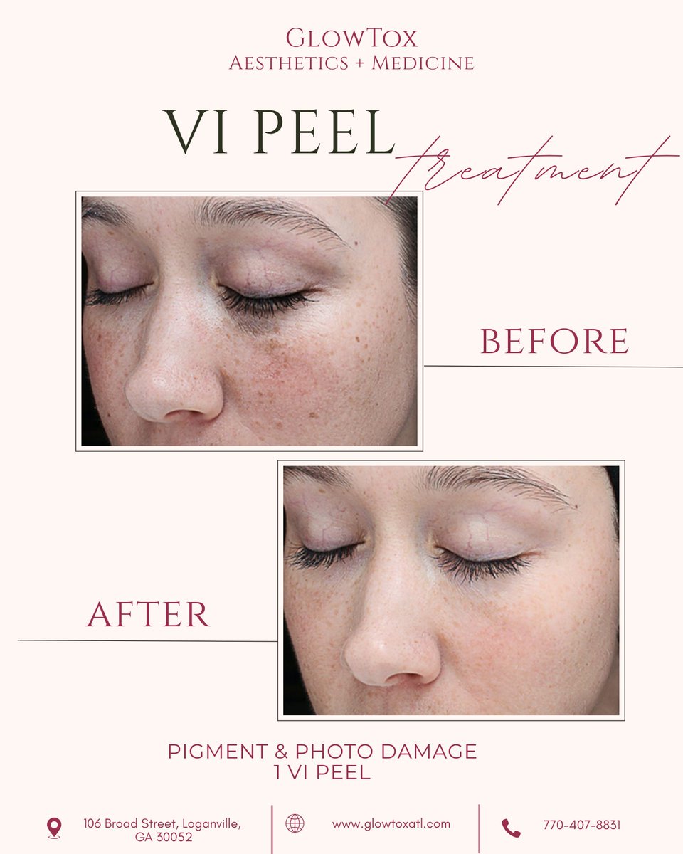 TanekaMyrelc's tweet photo. Your skin can change. See these VI Peel before-and-after results from different skin journeys. This professional chemical peel helps improve acne, hyperpigmentation, acne scars, uneven tone, and overall texture. Start your journey at GlowTox https://t.co/FTVfaAuYUN