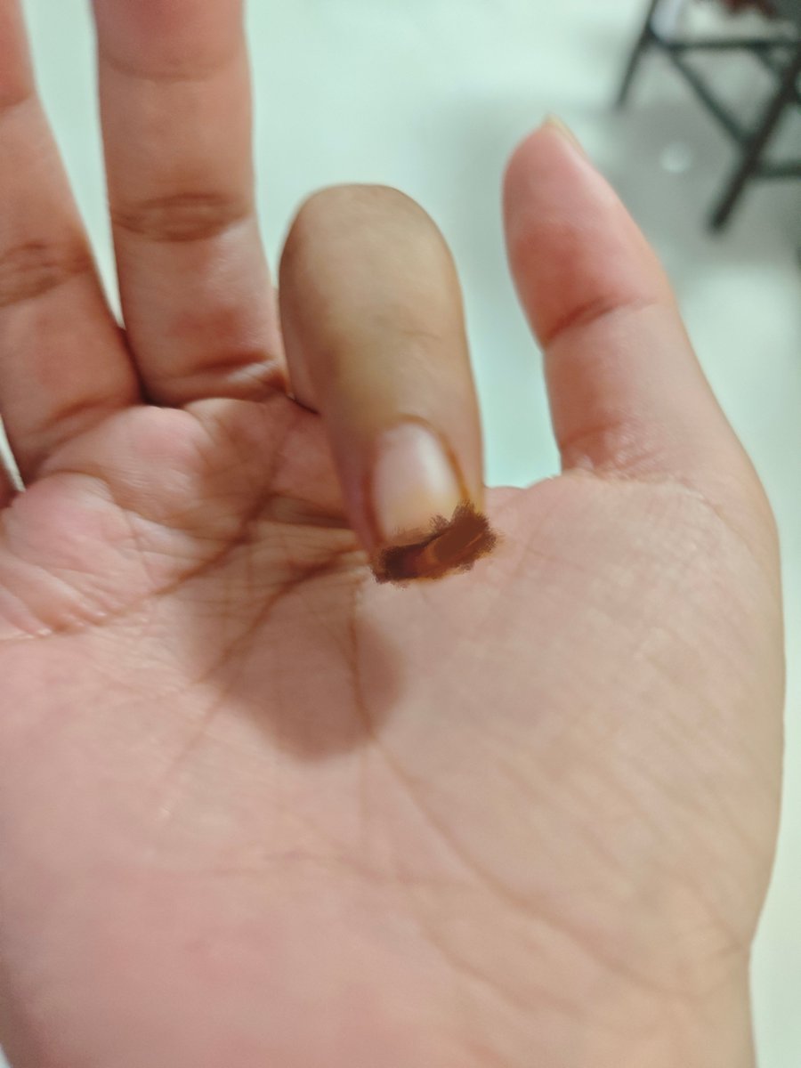 juzimmmTT's tweet photo. 终于拆线了 但因为一直用纱布固定的原因 我的食指没办法弯曲…💧

やっと糸を抜いたけど、ずっとガーゼで固定してたから、人差し指が曲がらない…💧 https://t.co/HJOjLYmPVZ