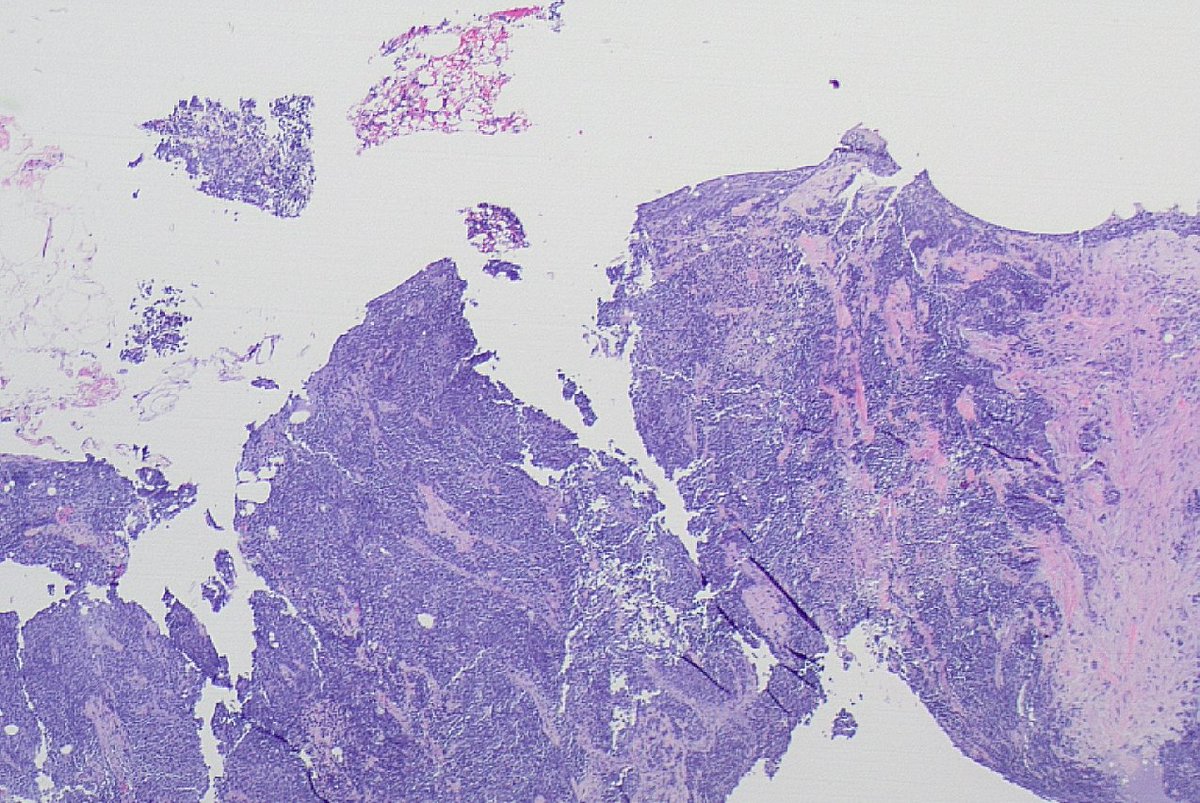 mhassanaimc's tweet photo. This triple negative breast cancer with neuroendocrine morphology with Ki-67 of 90% and no known lung mass. How the biopsy should be signed out? #breastpath https://t.co/bw69EdqTfY