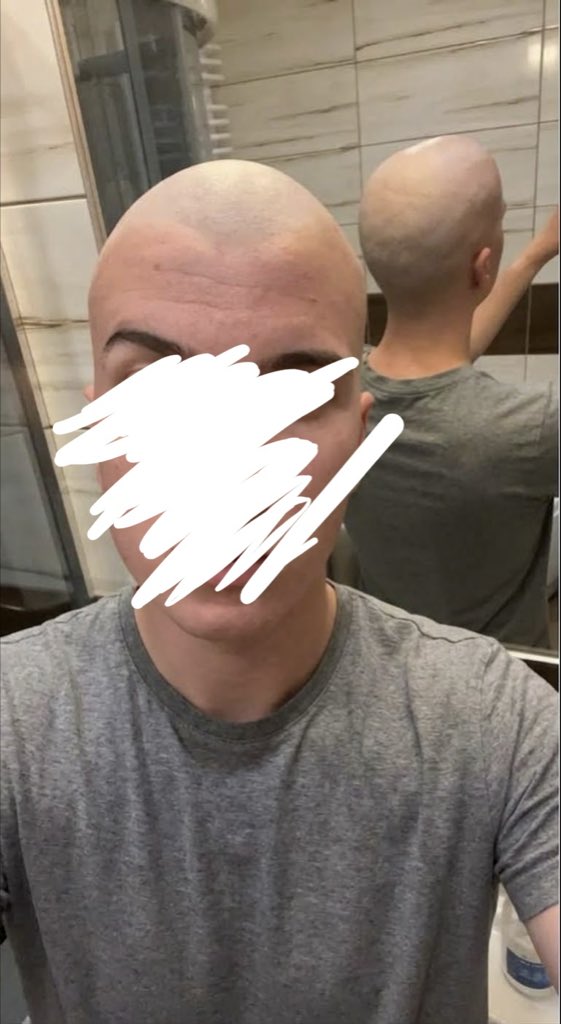 dann_5qq's tweet photo. I'm bald now 🙃 https://t.co/RKEPErhzW8