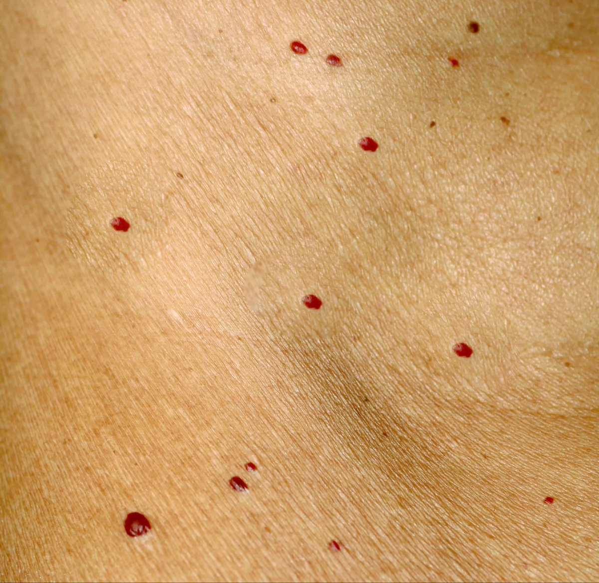 cavepaleo's tweet photo. Scientifically proven causes of CHERRY ANGIOMAS:

1) 2-butoxyethanol (2-BE)
Found in:
- Cleaning agents (floor strippers, wax removers, degreasers, glass and multipurpose cleaners, carpet and upholstery cleaners, laundry stain removers)
- Paint products (strippers, thinners, paints, varnishes, lacquers)
- Industrial products (hydraulic fluids, metal-cleaning solvents, printing inks)

2) Brominated flame retardants
Found in:
- Treated furnishings (foam furniture, mattresses, vehicle upholstery, carpet padding)
- Electronics (housings, circuit boards)
- Insulation (flame-retarded polystyrene)

3) Bromide-containing foods
- Nuts (Brazil nuts, pistachios, walnuts, chestnuts)
- Dried herbal tea ingredients (hibiscus flowers, strawberry leaves, chamomile flowers, rooibos leaves, yerba maté leaves)
- Spices and seeds (turmeric powder, cumin seeds, fennel seeds, black/white/green peppercorns, sesame seeds)
- Leafy vegetables and herbs (arugula/rocket, Swiss chard, tarragon)
- Rice
- Coffee beans

4) Other bromine-containing products
- Pool and spa chemicals (bromine sanitizers)
- Personal care products (bronopol-containing cosmetics and wipes)
- Fumigants (methyl bromide)
- Food additives (bromated flour in baked goods, brominated vegetable oil in drinks)

5) Other compounds
- Mustard agents (nitrogen mustard, sulfur mustard)
- Medications (tamsulosin, ipratropium bromide, cyclosporine, ramucirumab, infliximab, tacrolimus, mometasone)