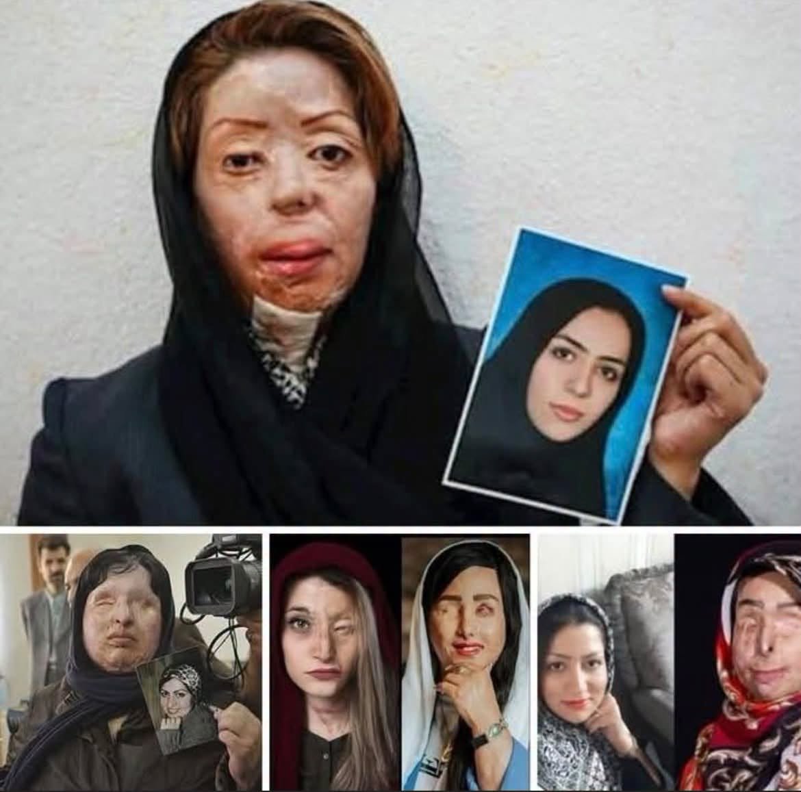 skeppare_ronny's tweet photo. Maryam Augustina Axelsson 

Detta är inte AI-bilder.
Detta är ett kvinnoansikte eller det som blev kvar av det.
Sönderfrätt av syra, smällt av hat och deformerat av händer som tillhör IRGC och religionpolisen i Iran.
Det är detta de menar när de säger "frivillig hijab".

Låt bilden bränna sig fast, för det är precis vad syran gjorde
och nu vill jag att ni lyssnar på tystnaden.
Den tystnaden kommer från Vänstern och från Nooshi Dadgostar.

Hon som aldrig missar en chans att tala om kvinnokamp, om systerskap, om förtryck. Men när förtrycket har skägg, när det ropar Allahu Akbar och kastar syra då blir hon stum.

Det är lätt att vara feminist mot vita män i kostym men det kräver ärlighet att vara feminist mot islamister vilket som Nooshi Dadgostar har inte den ärligheten i sig.

Vänster kallar förtrycket för "kultur" för att slippa bekämpa det.
De kallar tvånget för "identitet" för att slippa se offret.
De smyckar burkan med ordet "mångfald" medan kvinnorna under den kvävs.

Dela detta om du också tycker att Nooshi Dadgostar använder islamister för att få makten och islamister använder henne för att få Sverige.