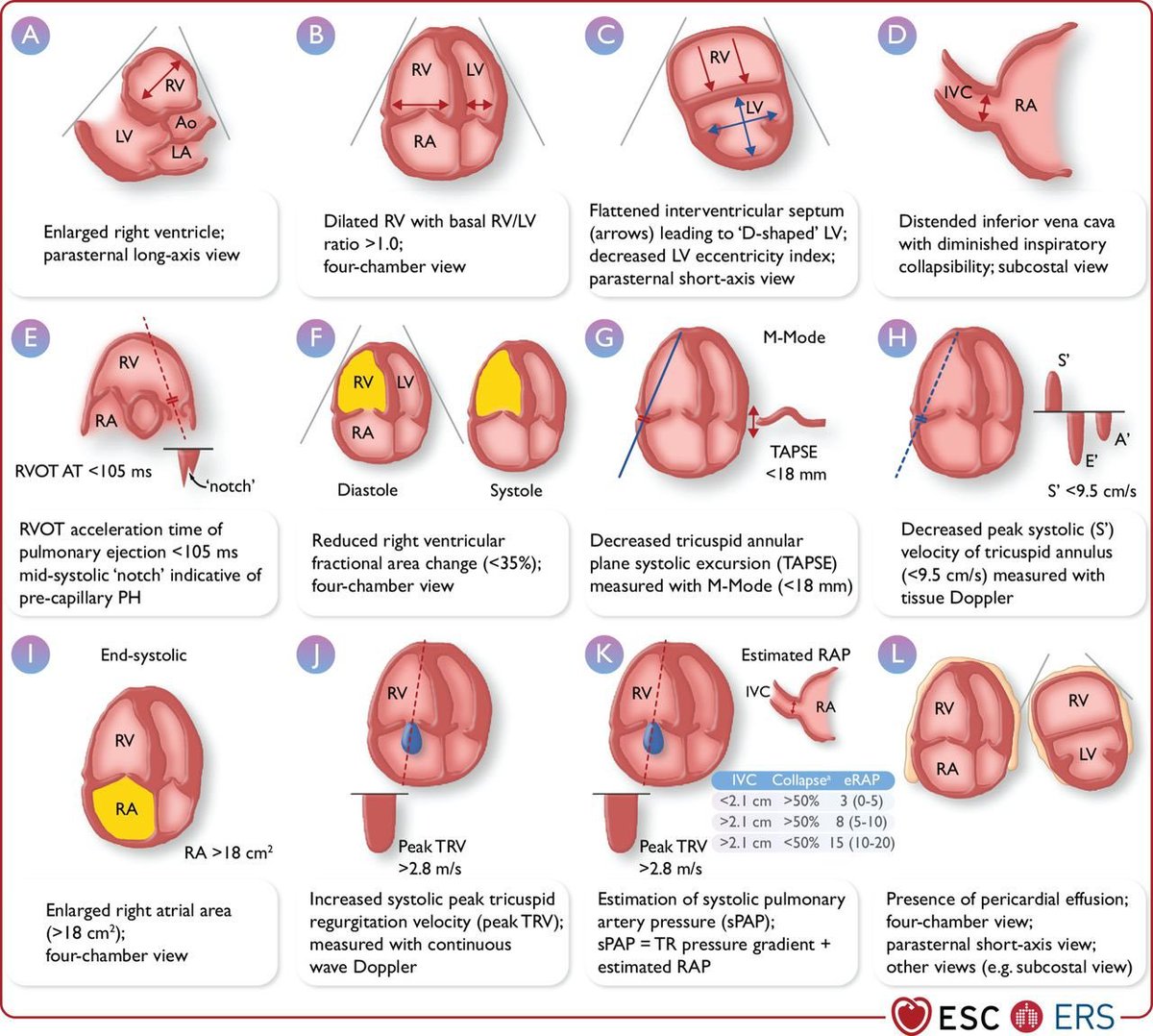 TrackYourHeart's tweet photo. Echocardiographic parameters suggesting pulmonary hypertension

How do you recognize PH on echocardiography?

The 2022 ESC/ERS Guidelines recommend assessing multiple parameters rather than relying on a single measurement.

Key findings include:
1️⃣ Peak TRV >2.8 m/s
2️⃣ RV/LV basal diameter or area ratio >1.0
3️⃣ Flattening of the interventricular septum
4️⃣ RVOT acceleration time <105 ms or mid-systolic notching
5️⃣ TAPSE/sPAP ratio <0.55 mm/mmHg
6️⃣ RA area >18 cm²
7️⃣ IVC >21 mm with reduced inspiratory collapse
8️⃣ PA diameter >25 mm
9️⃣ Early diastolic pulmonary regurgitation velocity >2.2 m/s

Importantly, TRV should not be interpreted in isolation. Additional signs from at least 2 different categories are required to modify the echocardiographic probability of PH.

Echocardiography estimates the probability of PH; right-heart catheterization is required for definitive haemodynamic diagnosis. 

Source: 2022 ESC/ERS Guidelines for the diagnosis and treatment of pulmonary hypertension.