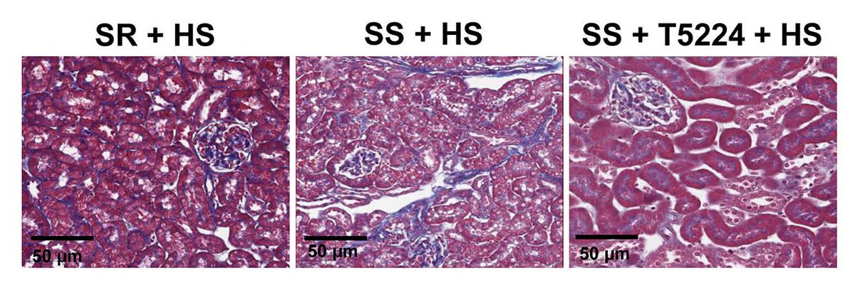 CircRes's tweet photo. @drtasir2011 et al reveal #AP-1 as a key transcriptional driver linking sodium, immune activation & #SSBP. Learn more at https://t.co/A39817InWh
@annetkiraboc1 @ashleymutchler @Mohamma91591696 @MDemirc1 @PorciaHaynes @jmafolabi @MaboodK05962100 @McMillan_RonK https://t.co/M7M1rB69jW