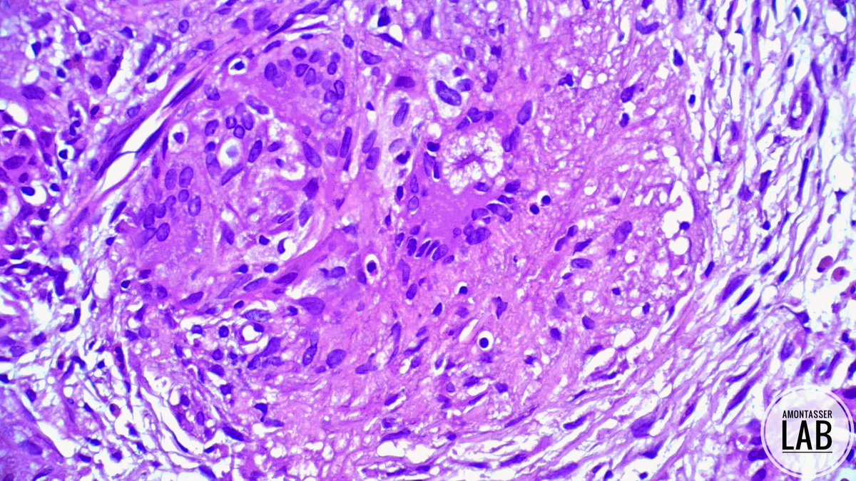 AMontasserMD's tweet photo. Love the times when you have the good “or let’s say the better” news 🙂

F 65Y, with history of bilateral breast cancer presenting with widespread nodal and hepatic lesions on follow up scans 🩻

🔬 Biopsies from LN and Liver 👇🏽 

#Pathology #PathTwitter #PathX https://t.co/8QeV2ZU980