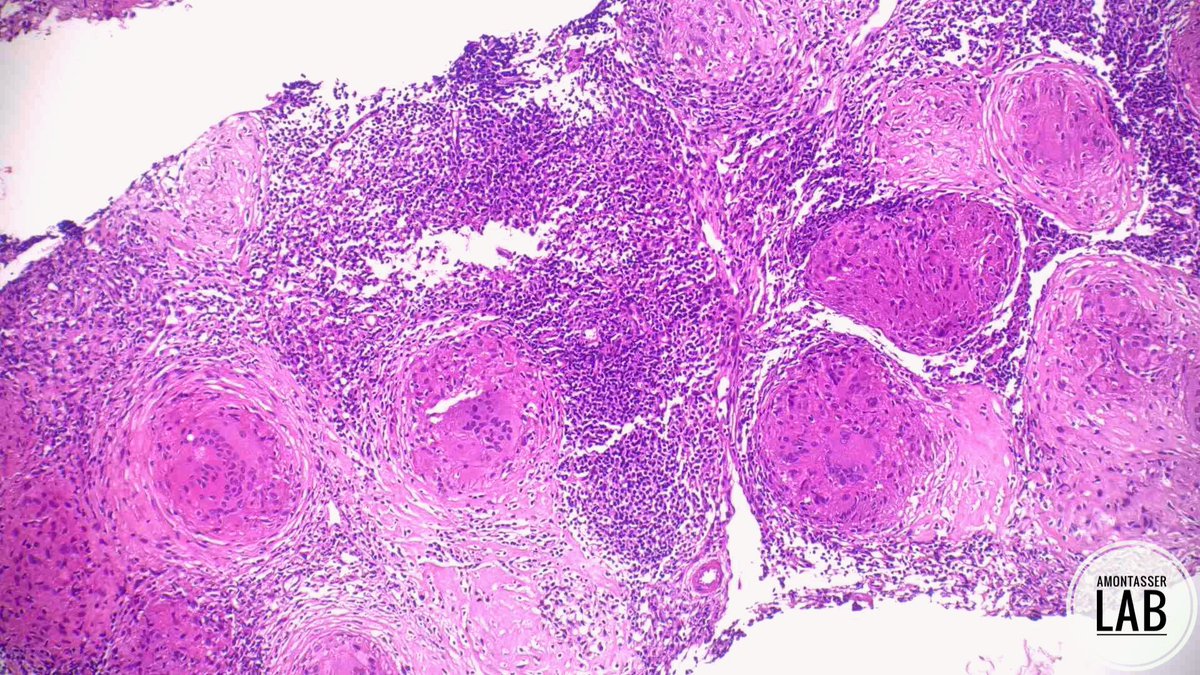 AMontasserMD's tweet photo. Love the times when you have the good “or let’s say the better” news 🙂

F 65Y, with history of bilateral breast cancer presenting with widespread nodal and hepatic lesions on follow up scans 🩻

🔬 Biopsies from LN and Liver 👇🏽 

#Pathology #PathTwitter #PathX https://t.co/8QeV2ZU980