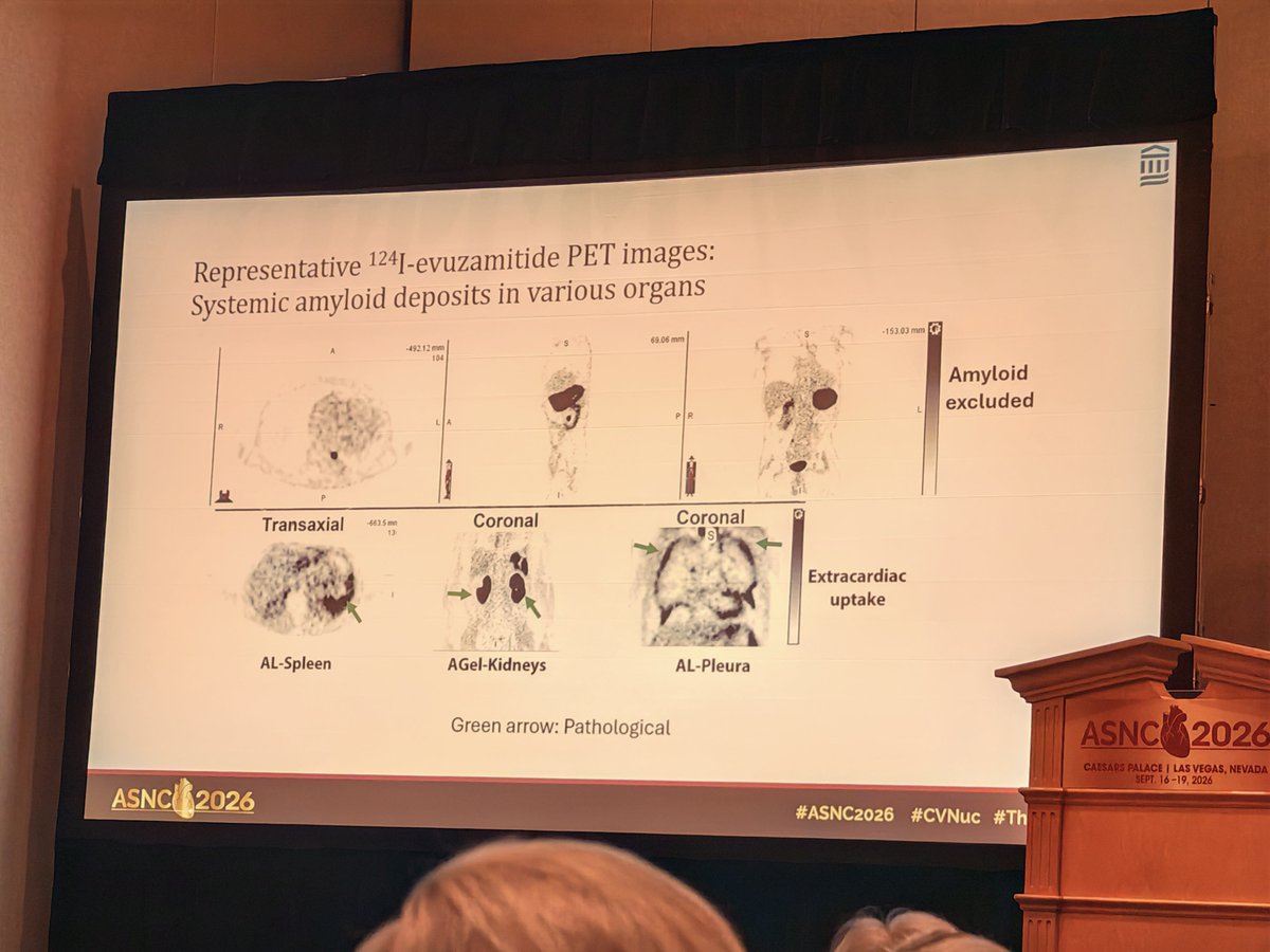estelais's tweet photo. Late breaking clinical trials: #Reveal study โจ#ASNC2026 @MyASNC @DorbalaSharmila
๐ Evuzamitide can detect the Amyloid deposit in advance of other imaging methods
๐Cover the entire body and detect deposit in different organs
#ThinkPET #ThinkAmyloid
๐ @UHegenbart @VietHeartPA @CesiaGallegos @NotNoninvasive @sarahcud @nishantshahmd
