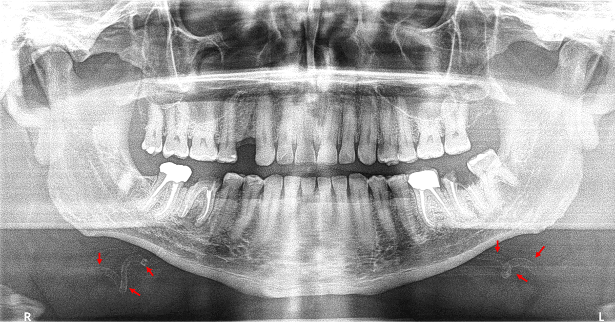 dentometric's tweet photo. Calcificación bilateral de la arteria facial

Enlace: https://t.co/45LhyfFMVq https://t.co/qWACRyKq7q