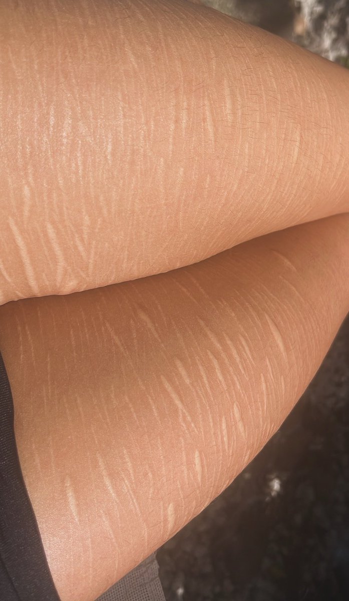 bkvxmp's tweet photo. Nicely healed❤️ #sh #sfx #selfharm #beans #styros #moothunt〃・ #makeup #razors https://t.co/sMO7mkjAFq