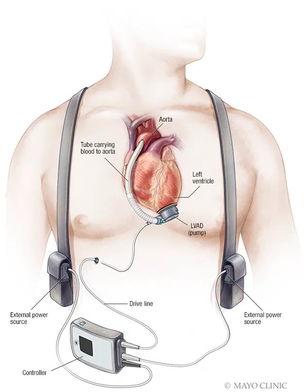 JAAG1i's tweet photo. اليوم وحدة من مريضاتي كان عندها جهاز LVAD، والمثير للدهشة أثناء الـassessment، لما حطيت السماعة على منطقة القلب؛ كان صوت النبض كأنه صوت روبوت أو ماكينة!
والأصعب أنها مركبة طرف صناعي بسبب مضاعفات من نقص التروية):
ف صرنا نمازحها نناديها Ms.Robot ومبسوطة على اللقب😂♥️♥️ https://t.co/sHo9rQKrjW