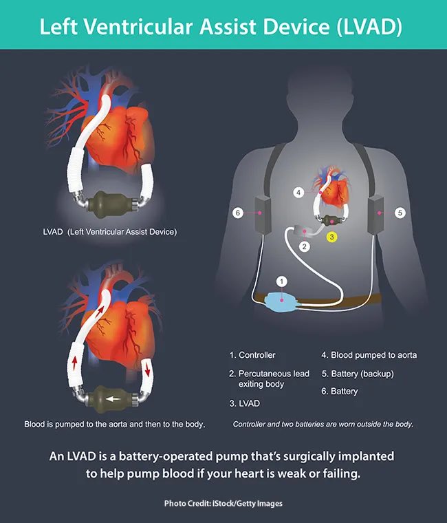 JAAG1i's tweet photo. اليوم وحدة من مريضاتي كان عندها جهاز LVAD، والمثير للدهشة أثناء الـassessment، لما حطيت السماعة على منطقة القلب؛ كان صوت النبض كأنه صوت روبوت أو ماكينة!
والأصعب أنها مركبة طرف صناعي بسبب مضاعفات من نقص التروية):
ف صرنا نمازحها نناديها Ms.Robot ومبسوطة على اللقب😂♥️♥️ https://t.co/sHo9rQKrjW