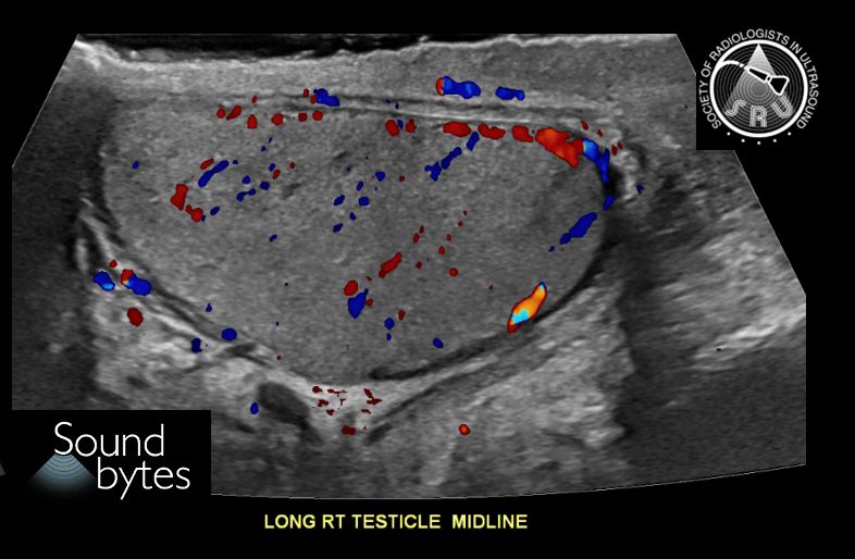 sruradiology's tweet photo. 80-year-old patient with testicular pain and swelling. What's your sound diagnosis?
Case courtesy of Marta Flory, MD, Stanford, @MartaFloryMDRad
#RadResidents #ultrasound #RadInTraining https://t.co/pAcwWT99dj