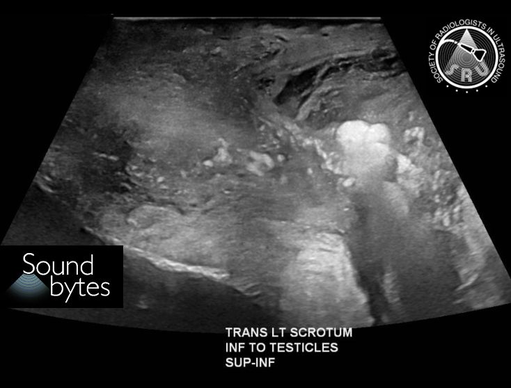 sruradiology's tweet photo. 80-year-old patient with testicular pain and swelling. What's your sound diagnosis?
Case courtesy of Marta Flory, MD, Stanford, @MartaFloryMDRad
#RadResidents #ultrasound #RadInTraining https://t.co/pAcwWT99dj