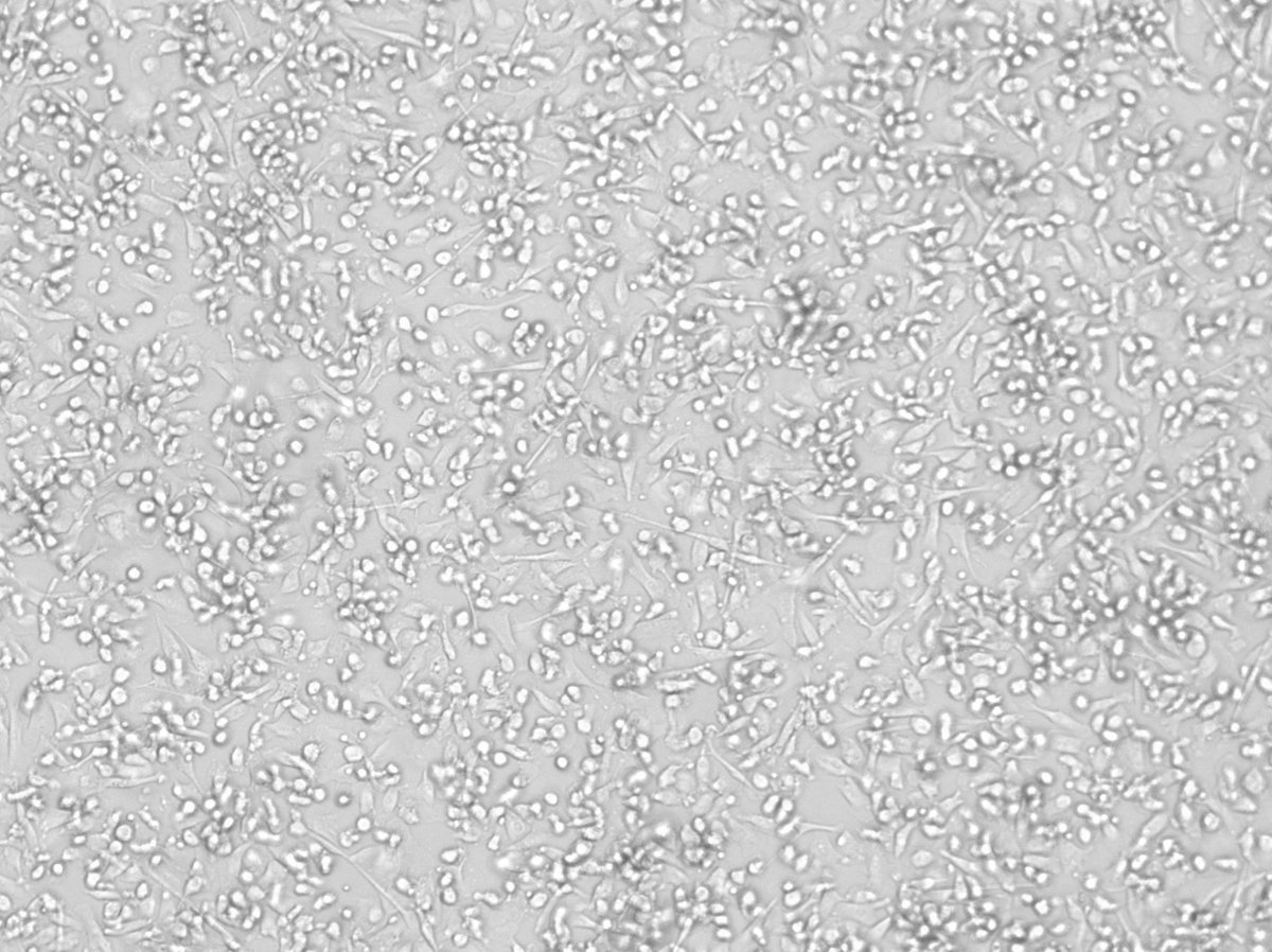 HollensbeAmanda's tweet photo. These two pictures were taken 3 weeks and 3 days apart.

The image on the left was taken the day before Braelyn received DCVax #3.

It’s a microscopic image of Braelyn’s own dendritic cells loaded with her tumor lysate.

In other words… this is the process by which her immune system is being taught to recognize her cancer.

To most people, it probably looks like a boring image on a computer screen.

To us, it’s hope.

It represents months of surgeries, shipping tumor tissue across continents, leukapheresis, manufacturing, quality control, and the dedication of an extraordinary team of scientists—all culminating in these tiny immune cells being prepared to help Braelyn’s immune system recognize the unique targets in her tumor.

I said when I first saw this image that this masterpiece deserved to be matted, framed and given a place of honor on our wall at home.

Because to our family, this isn’t just science.

It’s art. It’s hope. It’s Braelyn’s own immune system being given information about the enemy it needs to find.

And then there’s the other picture.

Three weeks and two days after Braelyn received DCVax #3, that MRI was taken.

The radiologist’s conclusion:

“No evidence of disease recurrence.”

Her UCLA neurosurgical team and tumor board subsequently reviewed the images themselves and told us they could see no tumor tissue—including the residual tumor that had been left behind at surgery.

The first picture is hope under a microscope.
The second one is the image we prayed for.

We know this journey isn’t over. Braelyn will continue her DCVax treatments, and we’ll continue taking things one scan, one treatment and one day at a time.

But these two pictures?

I think I may need to frame them together. ❤️
#DCvaxForBraelyn
$NWBO
@AdventBio