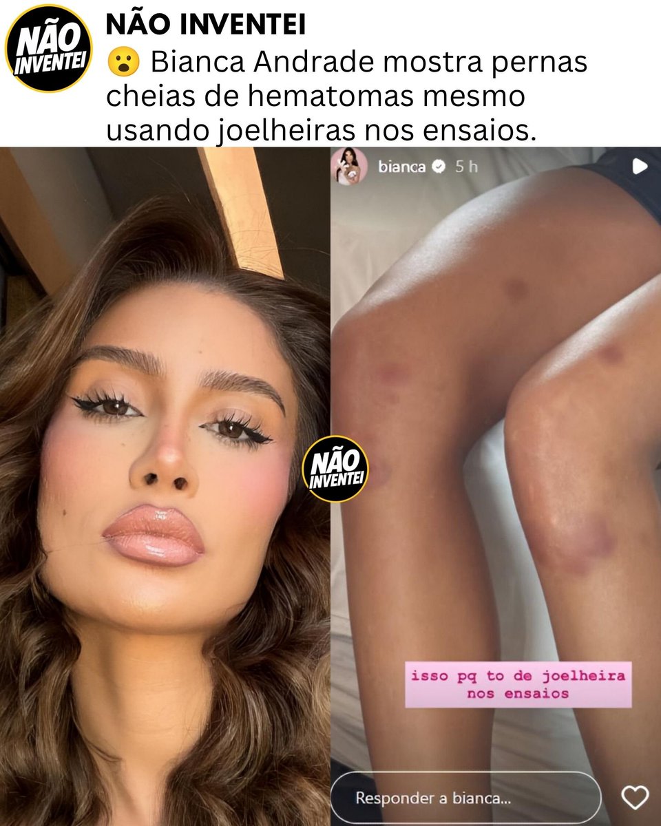 naoinventeibr's tweet photo. 😮 Bianca Andrade mostrou as pernas cheias de hematomas por causa dos ensaios da Dança dos Famosos. Ela ainda contou que as marcas apareceram mesmo usando joelheiras durante os treinos. #BiancaAndrade #BocaRosa #DancaDosFamosos https://t.co/a6ttXxPxeE
