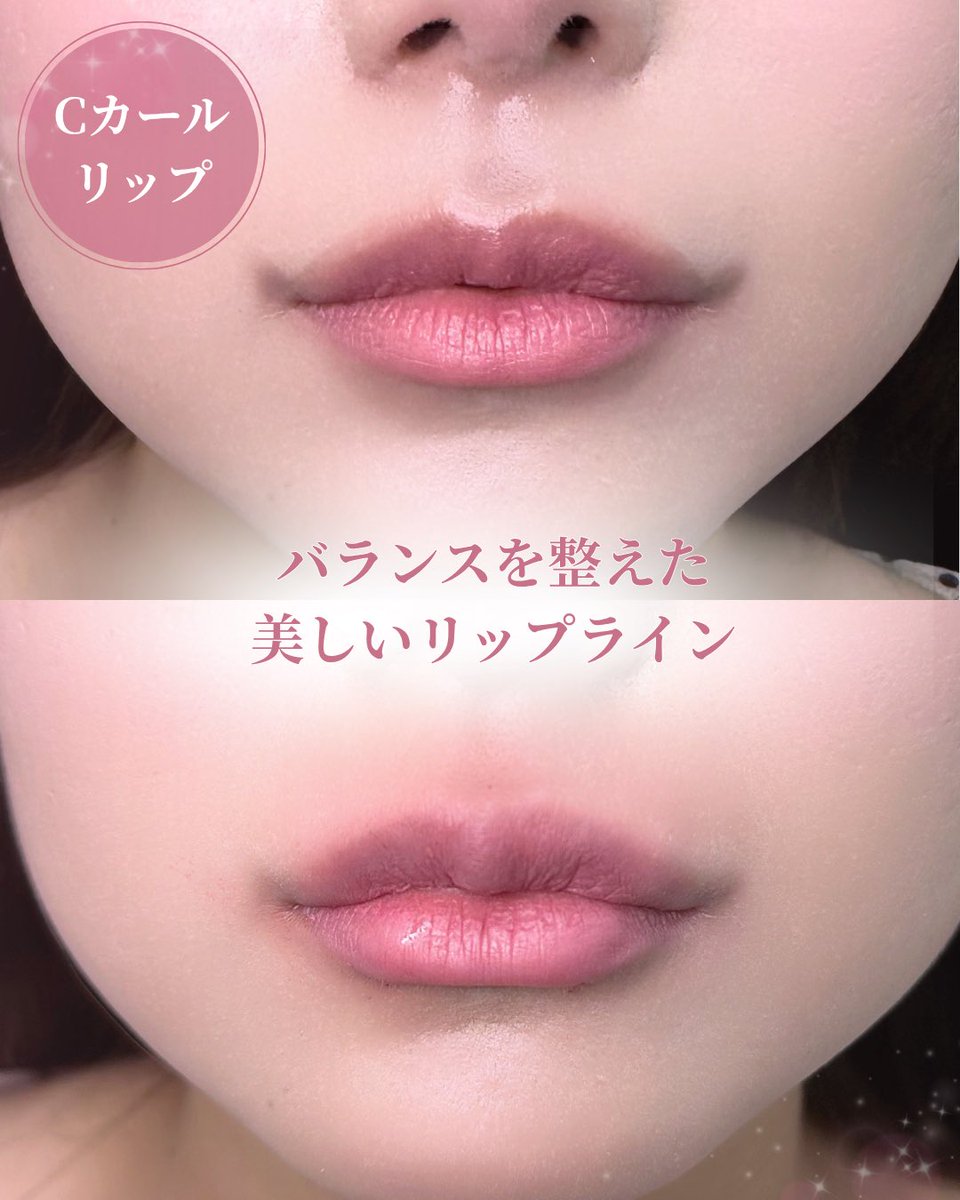 lula_tenjin's tweet photo. 唇ヒアルでふっくら魅力的な唇へ✨️

自然なボリューム感を出しながら、女性らしく柔らかな印象に🫧
唇の形やお悩みに合わせてデザインをご提案します
「口元の印象を変えたい」
そんな方にもおすすめです💁🏻‍♀️

 #ルラ美容クリニック  #ルラ美容クリニック福岡天神院  #唇ヒアル https://t.co/Hha0tRSY8J
