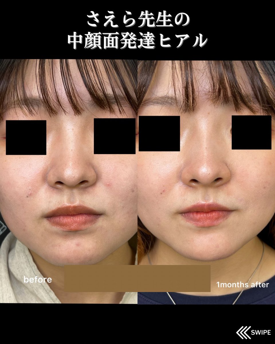 caetla_osaka's tweet photo. 【中顔面発達ヒアル】
貴族ヒアルと鼻中隔ヒアルを組み合わせて、中顔面の陥没感を減らして立体的な印象の顔に近づける施術です💉
貴族ヒアルによって小鼻の影が薄くなり、鼻ヒアルでさらに鼻に高さを出すことが可能です🌟 https://t.co/cx60H0Sebs