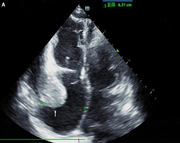 hsfeditor's tweet photo. 🧬Not all #cardiomyopathies look the same
A rare case of Danon disease revealed an unexpected phenotype: arrhythmogenic right ventricular cardiomyopathy (ARVC)
Genetic testing identified a novel LAMP2 variant, expanding the known cardiac spectrum of this rare disorder #Cardiology https://t.co/Jp6dCyKeCJ
