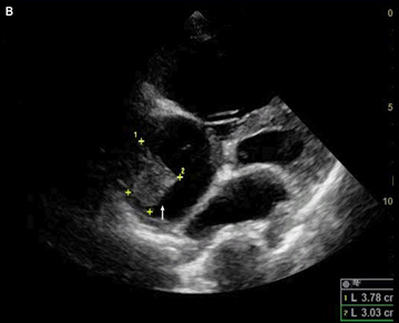 hsfeditor's tweet photo. 🧬Not all #cardiomyopathies look the same
A rare case of Danon disease revealed an unexpected phenotype: arrhythmogenic right ventricular cardiomyopathy (ARVC)
Genetic testing identified a novel LAMP2 variant, expanding the known cardiac spectrum of this rare disorder #Cardiology https://t.co/Jp6dCyKeCJ