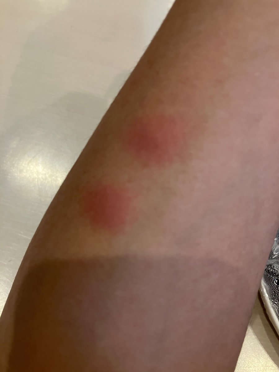 Vankzk's tweet photo. なんでよりによって私に二箇所刺すんだよ😡もう1人いただろ😡😡😡 https://t.co/b1ZrbRPnv6