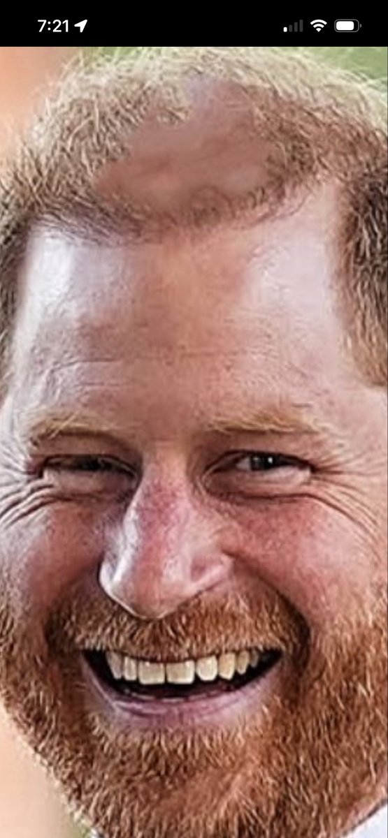 minimace's tweet photo. @hrrysgreysuit Double 0 Douchebag with the dueling Friar Tucks amassing on his nasty skull! The wrinkles and bags under his eyes and his increasingly drooping, enlarging  nose—he is truly hideous from stem to stern! #MeghansFox! #GingerNutSac! https://t.co/FkTcSjKi10