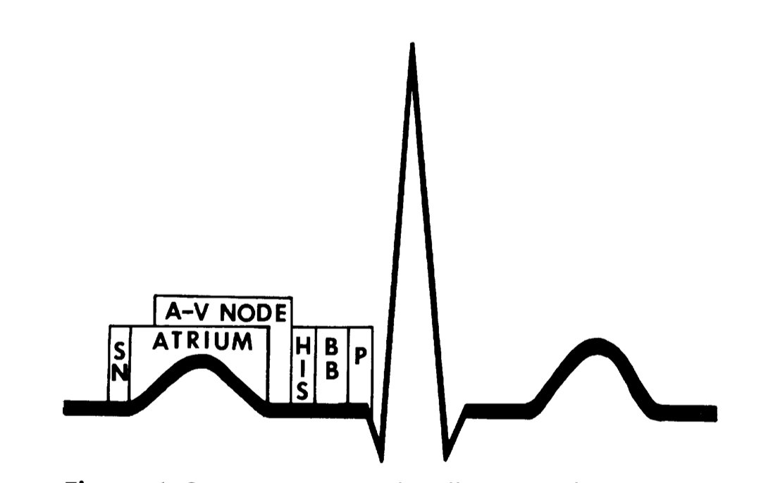 TrackYourHeart's tweet photo. How the Electrical Impulse Travels

The ECG is easier to understand when you stop seeing it as a collection of waves and start seeing it as a map of electrical activation.

The sequence is:
SA node
  ⬇️
atria
  ⬇️
AV node
  ⬇️
His bundle
  ⬇️
bundle branches
  ⬇️
Purkinje fibers
  ⬇️
ventricles

The P wave represents atrial depolarization.

After the atria depolarize, the impulse reaches the AV node, where conduction slows. This delay gives the ventricles time to fill before ventricular activation.

The impulse then travels through the His-Purkinje system, producing rapid ventricular depolarization and the QRS complex.

Finally, ventricular repolarization produces the T wave.

So when you look at a normal ECG:

P = atrial depolarization
PR interval = atrial-to-ventricular conduction
QRS = ventricular depolarization
T = ventricular repolarization

The key concept is that the ECG is not simply recording the heartbeat.
It is recording the timing and sequence of electrical activation through the heart.

That becomes clinically important when conduction is delayed or blocked. For example, abnormalities anywhere from the sinus node through the AV node and His-Purkinje system can produce characteristic ECG changes and bradyarrhythmias. 

And this is why understanding the normal pathway comes first.

Before you diagnose a conduction abnormality, know the normal conduction pathway.