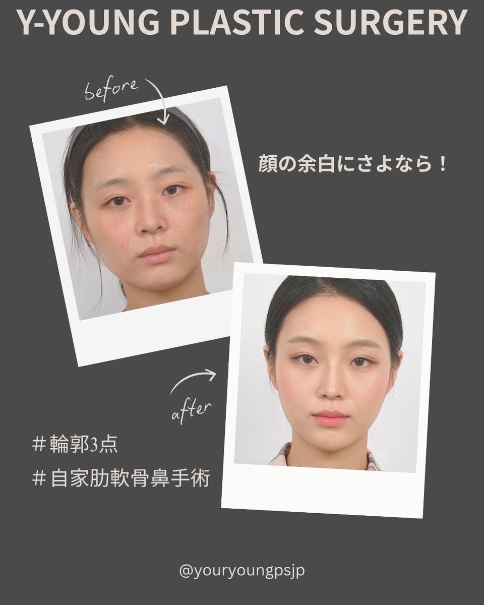 youryoungpsjp's tweet photo. 毎年ハイフや脂肪溶解注射、リフトアップに大金を使い続けるよりも、骨そのものを一度きれいに整える方が結果的にタイトでコスパが良い。😊💕

そう気づいた賢い20代・30代がキム・ヘヨン代表院長の輪郭3点を選んでる。💯💮

人生の後半を自信に満ちた小顔で過ごすための最高の投資。😊💕

#輪郭3点 #骨切り #小顔整形 #エラ削り #渡韓整形