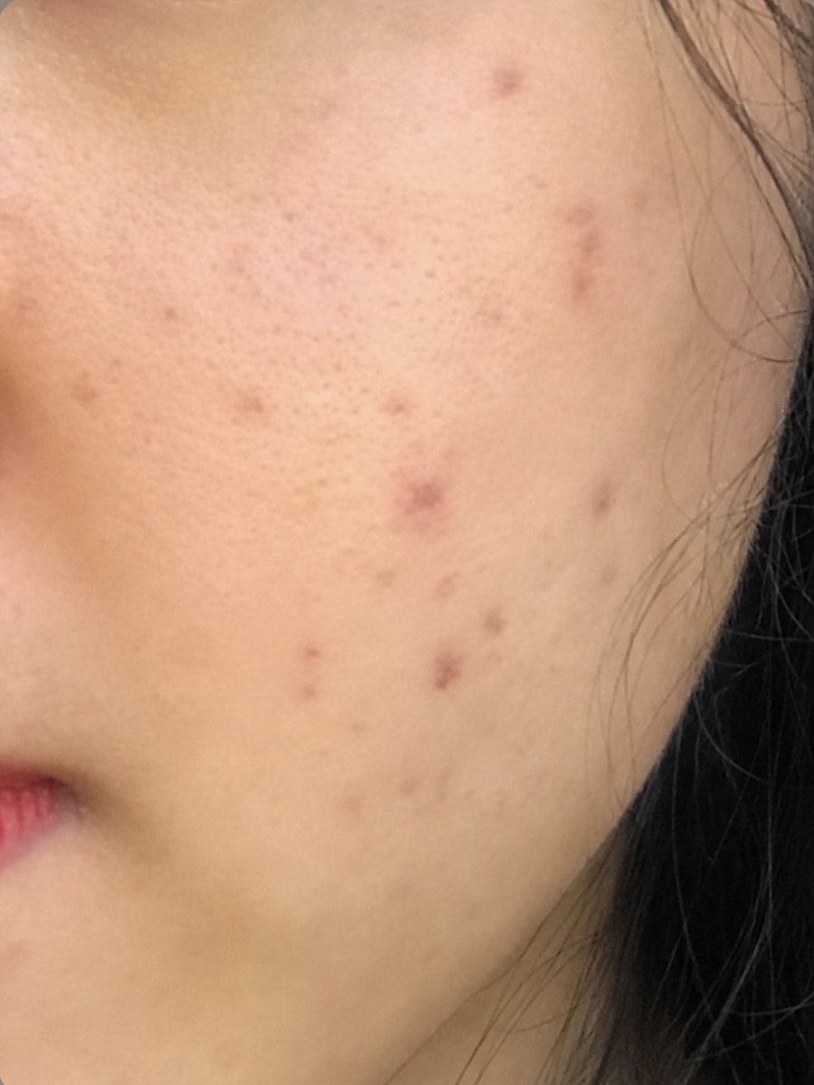 pistacigo's tweet photo. how "local skincare brand" did to my skin 😧🫶🏻 https://t.co/PJTVqrSAk8